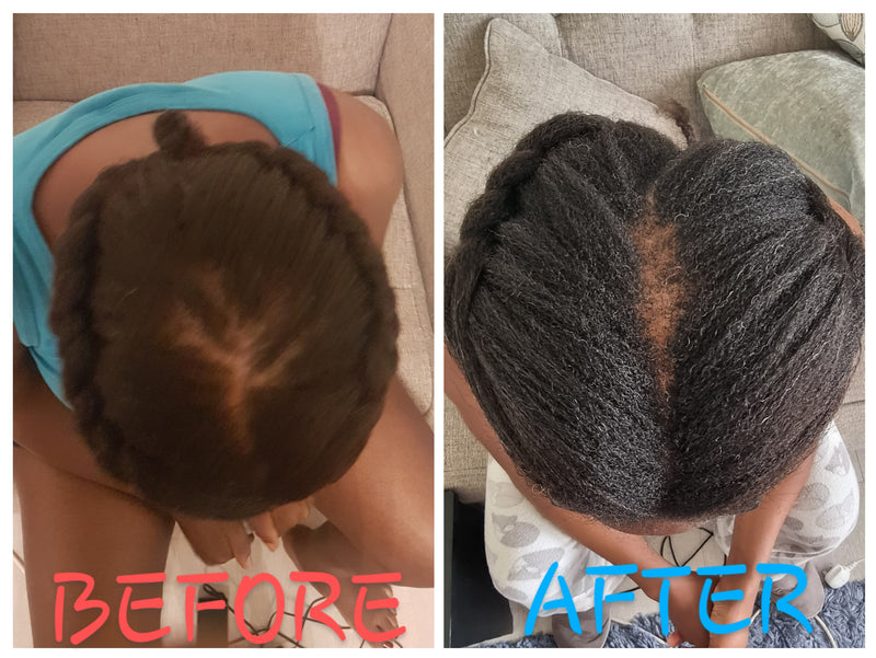 The Truth About Central Alopecia: Finding Hope and Healing